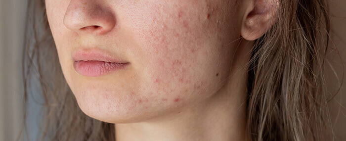 gros plan sur la peau d'un visage marqué par l'acné