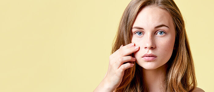 jeune adolescente atteinte d'acné modérée au visage