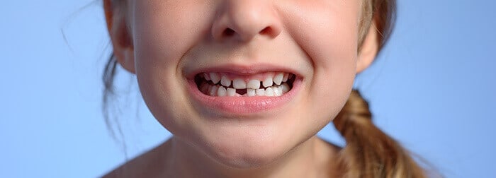 plan sur la dentition d'une fillette à qui il manque des dents