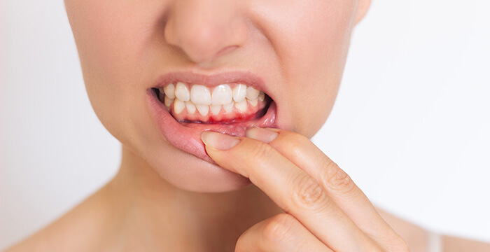 gros plan sur une bouche avec un aphte