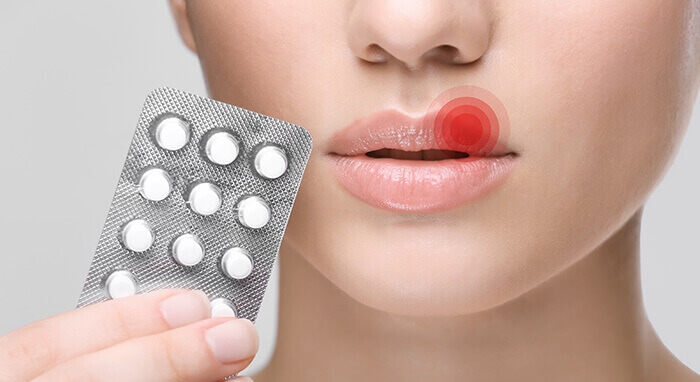 plaquette de comprimés antiviraux contre un bouton de fièvre