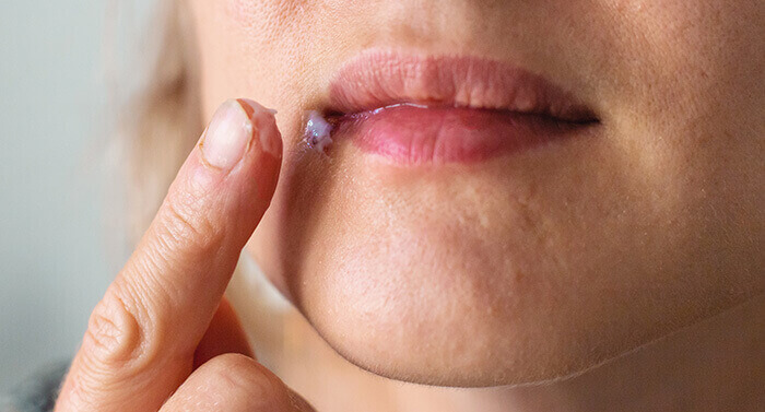 application d'une crème antivirale sur un bouton de fièvre au coin de la bouche