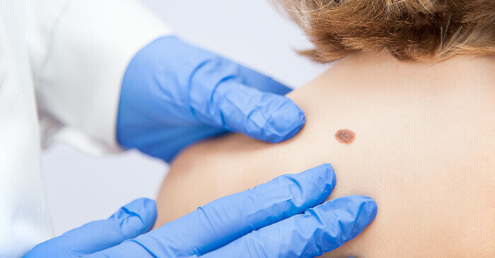 gros plan sur les mains gantées d'un médecin observant un grain de beauté