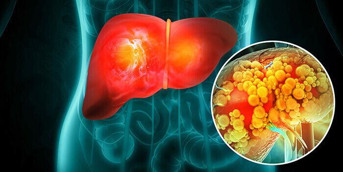 illustration d'une pathologie hépatique