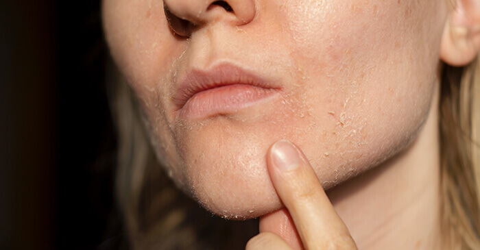 gros plan sur la peau très sèche au niveau du pourtour de la bouche d'une femme