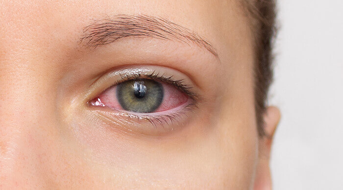 gros plan sur un oeil rouge et irrité