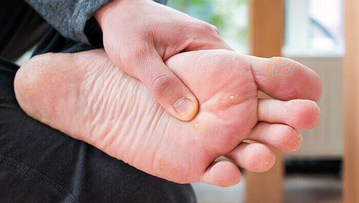 plante de pied d'un homme avec deux cors