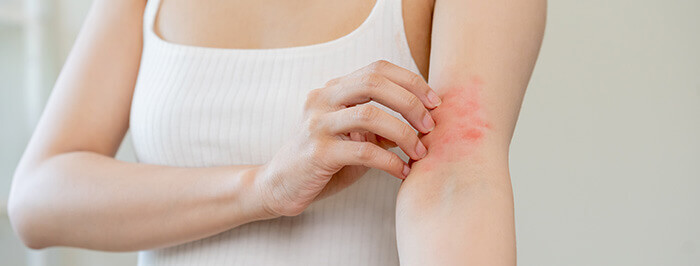 eczéma au niveau du creux du coude sur une peau atopique