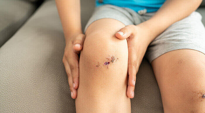 croute d'une plaie sur un genou