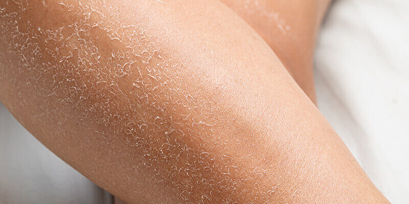 gros plan sur une peau sèche dont la barrière cutanée est abimée