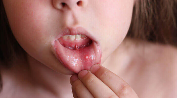 Plan sur un aphte placé sur l'intérieur de la lèvre inférieure