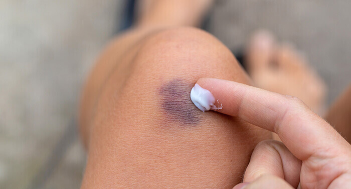 application de crème antalgique sur un hématome