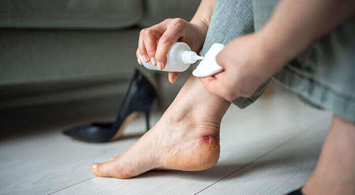 femme désinfectant une ampoule au niveau du pied à l'aide d'une compressse et d'un spray antiseptique