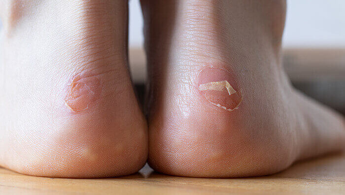 gros plan sur des talons avec des ampoules