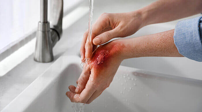 personne passant sa main brulée sous un filet d'eau