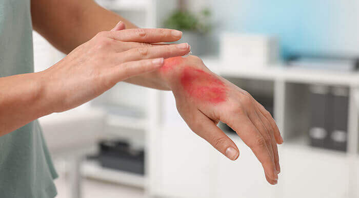 personne appliquant de la pommade sur une brulure au niveau de la main