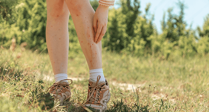 plan sur les jambes d'une femme infectée par la gale