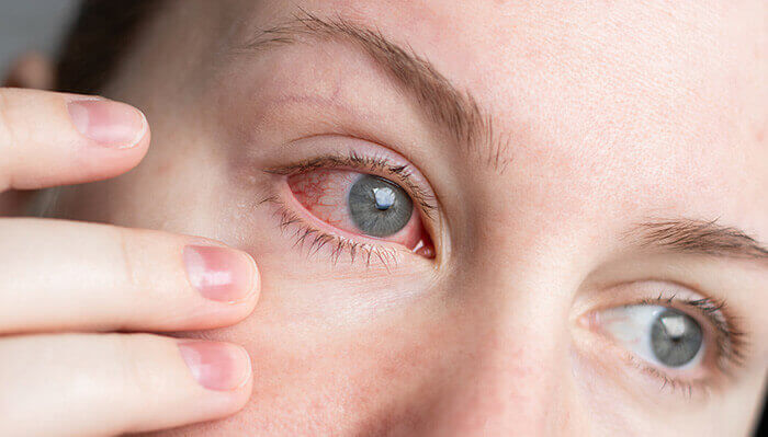 gros plan sur un oeil rouge souffrant d'une conjonctivite