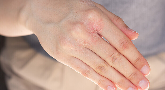 dermite de contact sur la main