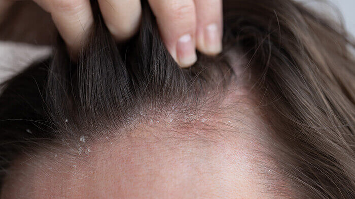 gros plan sur une dermite séborrhéique au niveau du cuir chevelu