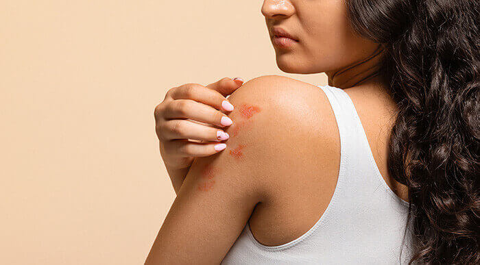 plan sur la peau irritée de l'épaule d'une femme