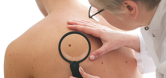 dermatologue examinant à la loupe un grain de beauté dans le dos d'un patient