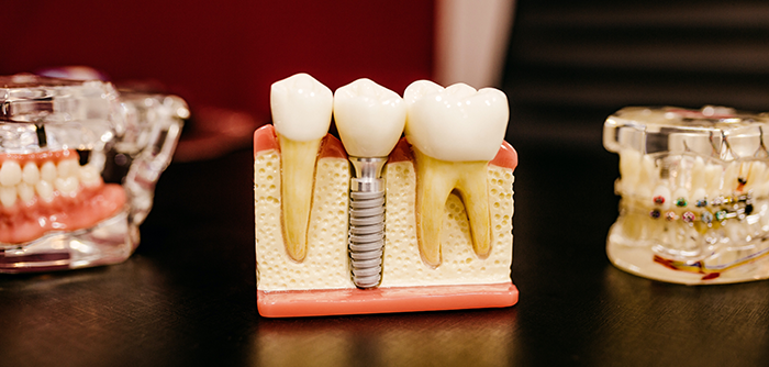 dents