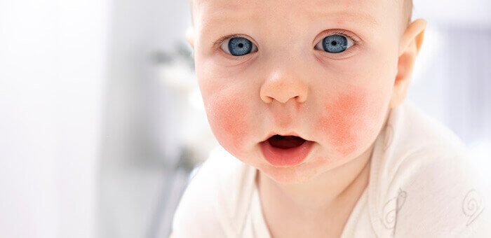 bébé présentant une poussée d'eczéma sur les joues