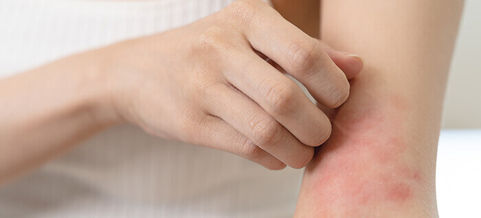 poussée d'eczéma dans le pli du coude