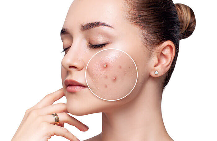femme présentant une peau acnéique