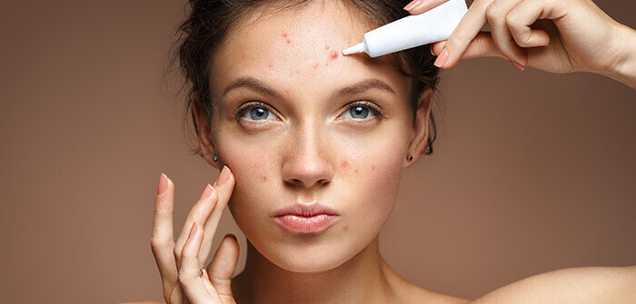 femme s'appliquant une crème sur des boutons d'acné