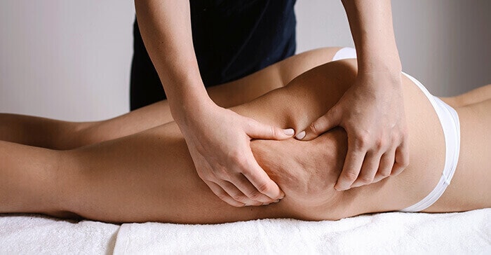 plan sur une zone de cellulite au niveau de la cuisse