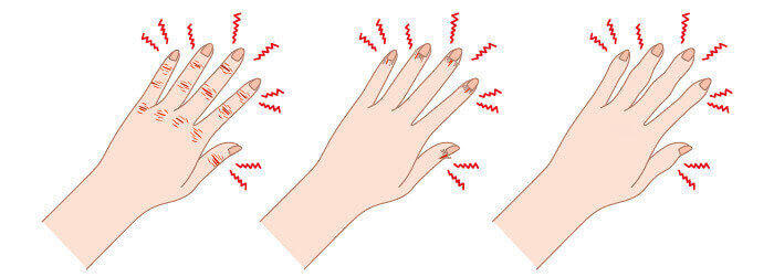 illustration d'engelures et de gerçures des mains
