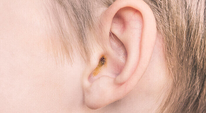 plan sur l'oreille d'un enfant avec du cerumen