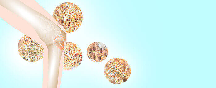 illustration de l'ostéoporose
