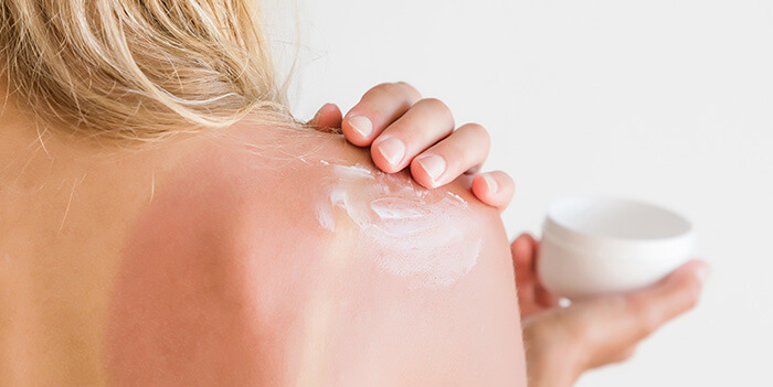 femme s'appliquant un soin après-soleil sur une peau échauffée