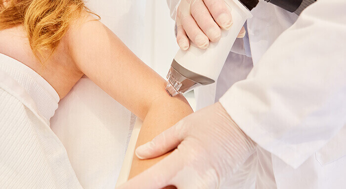dermatologue traitant une kératose pilaire au niveau du bras par laser