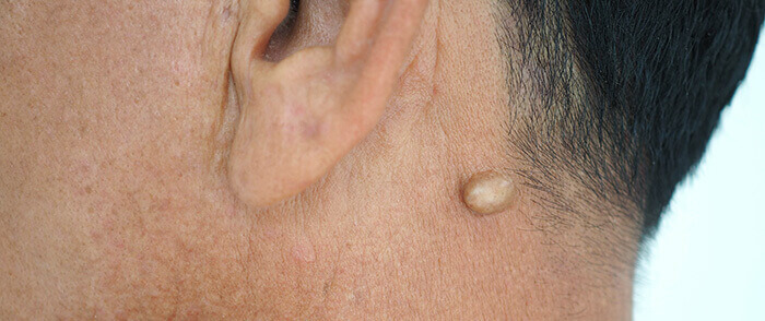 kyste sous la peau au niveau du cou