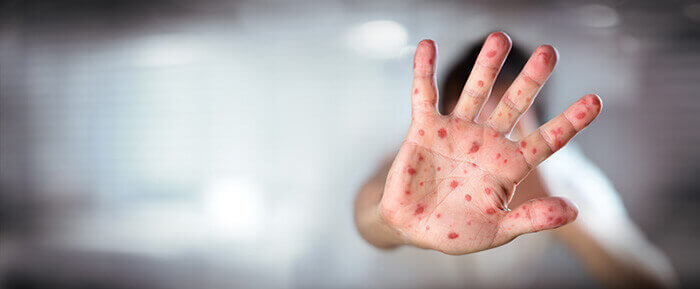 paume de main couverture de plaques rougeole