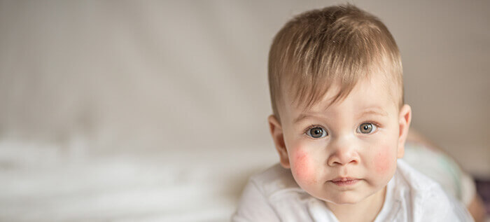 bébé présentant des plaques d'eczéma sur les joues