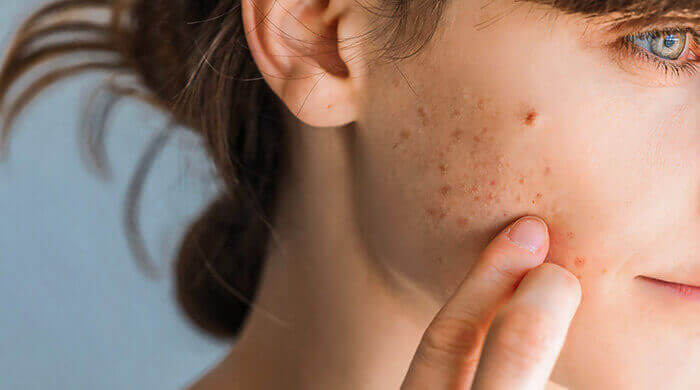 Plan sur la joue d'une femme souffrant d'acné