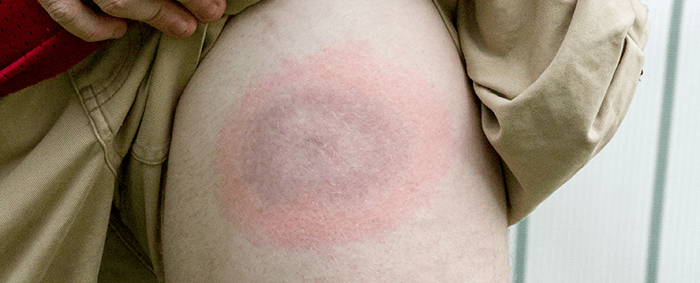 tache caractétistique de la maladie de lyme