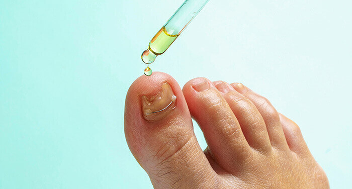 traitement d'une mycose de l'ongle avec des gouttes