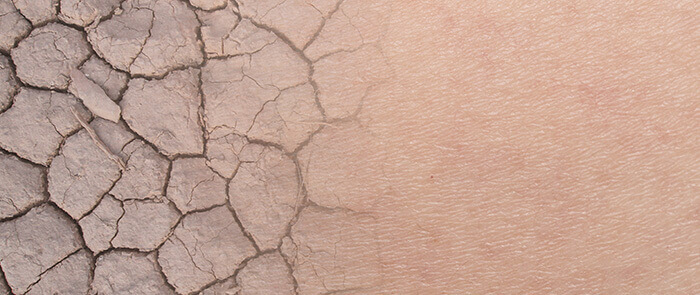 peau sèche craquelée