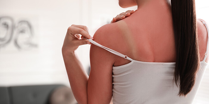 coup de soleil sur les épaules et le dos d'une femme