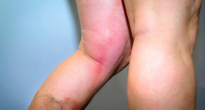 jambes rouge et gonflée présentant les symptomes d'une phlébite