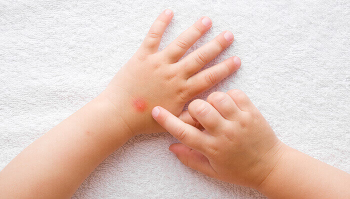 Bouton de moustique sur une petite main d'enfant