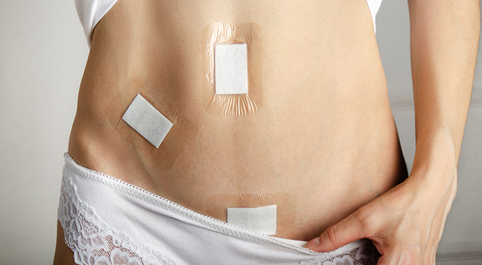 pansements placés sur des cicatrices sur le ventre d'une femme