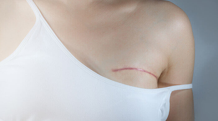 cicatrice au dessus du sein d'une femme