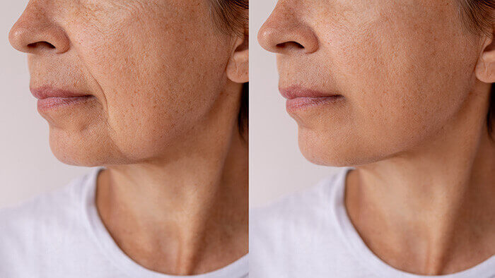 comparaison du menton d'une femme dont la peau est plus ou moins relâchée